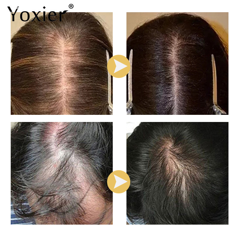 Intensive Growth Serum Prevent - Hair Care For Hair Growth 리뷰 및 가격